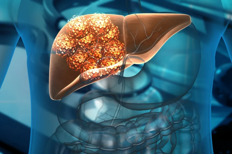 Təhlükəli xərçəng növünün inkişafını dayandırmağın  yolu tapıldı