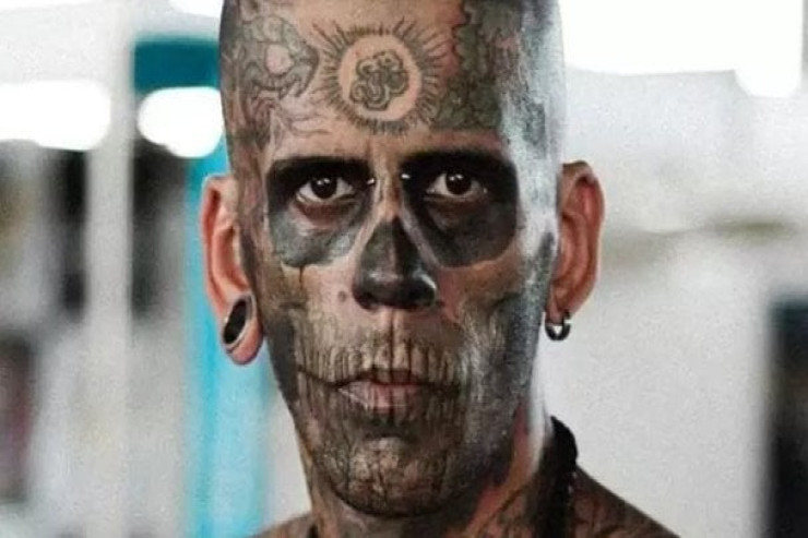 Bədəni 95 faiz döymə idi  - Silinəndən sonra görünüşü ŞOKA SALDI