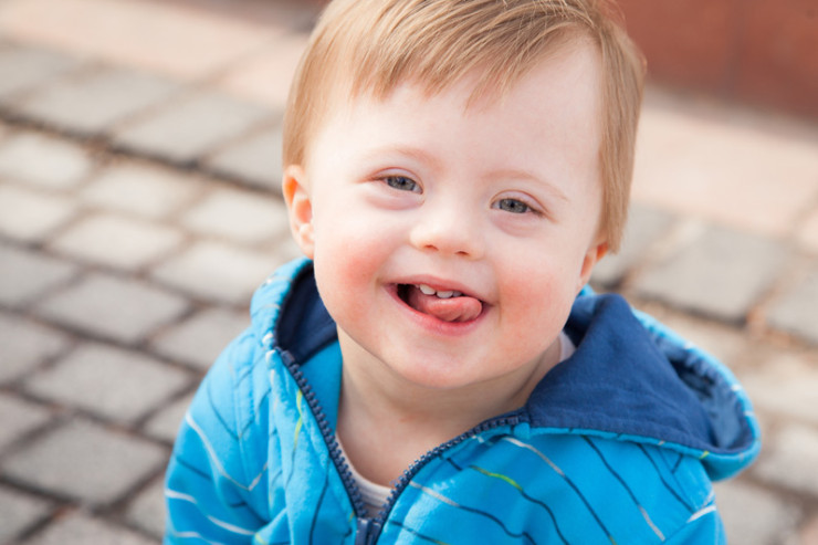 Daun sindromunun  müalicəsi üçün mühüm KƏŞF