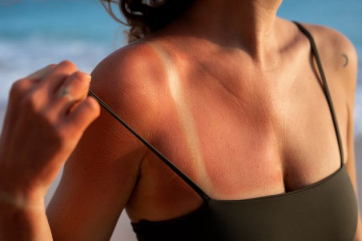 Günəşdə yanmısınızsa, ağrını tez bir zamanda yüngülləşdirməyin 3 ÜSULU 