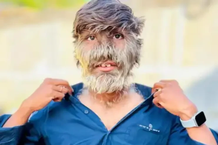 Dünyanın ən tüklü  üzünə sahib kişisi