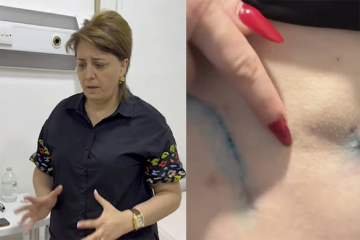 Daha bir “plastik cərrah” qalmaqalı  - “Bədənim çürüyür”+Video