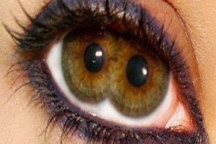 "Pupula duplex"  nədir?