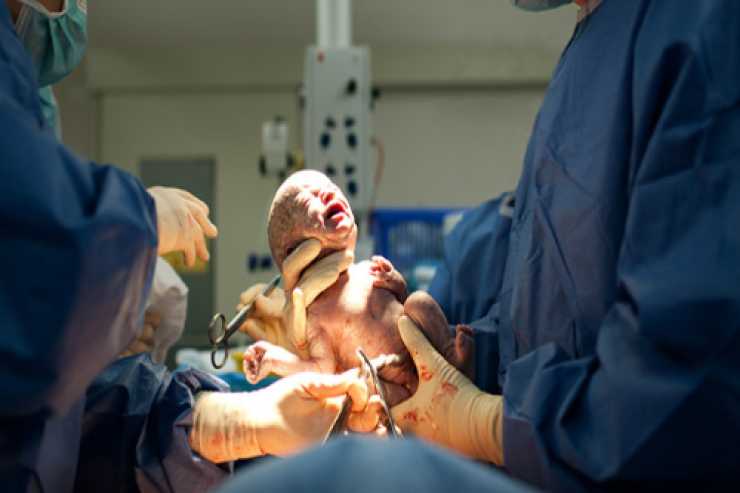 Azərbaycanda qeysəriyyə   əməliyyatı zamanı uşaq öldü 