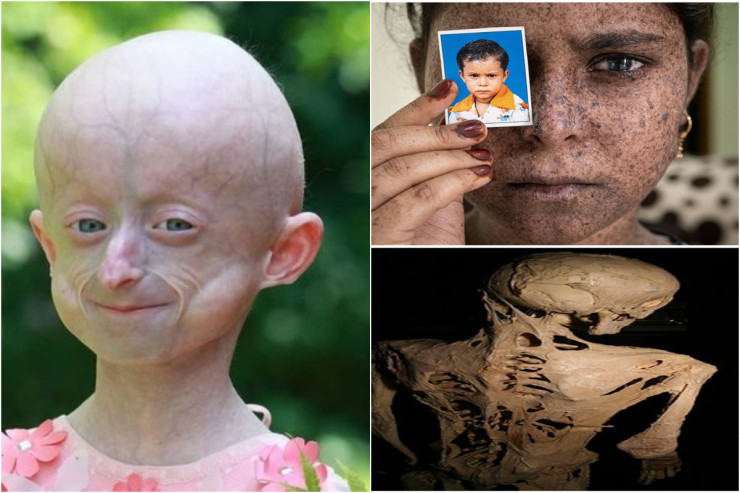 “Daş adam”, “Erkən yaşlanma” kimi nadir və qorxunc  XƏSTƏLİKLƏR – ARAŞDIRMA 