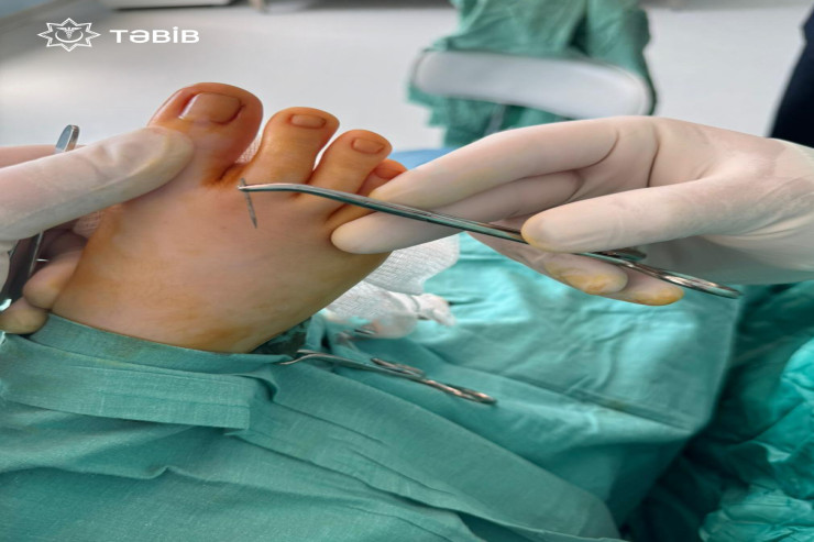 Bakıda uşağın ayağındakı iynə 14 gün sonra tapıldı 