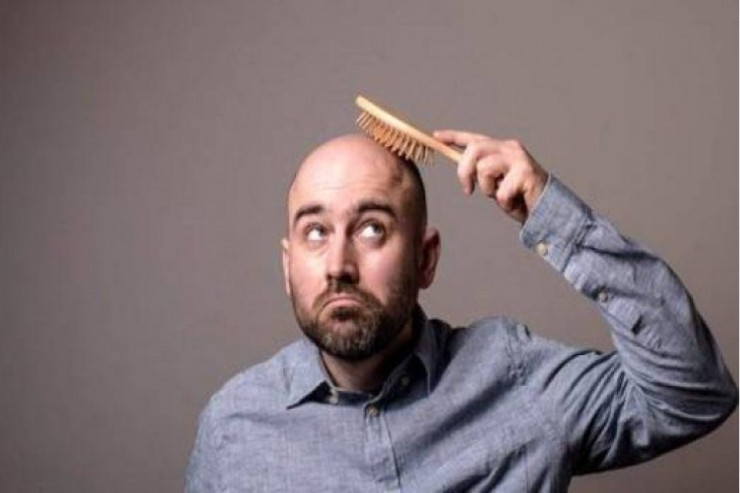 Kişilərdə keçəlləşmə artır   – Bəs səbəb nədir? - VİDEO 