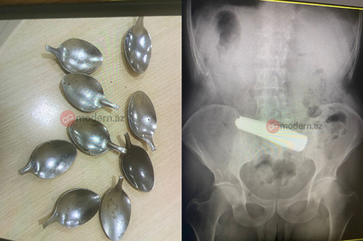 Bakıda ŞOK:  9 ədəd qaşıq uddu - VİDEO 