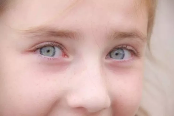 Uşağın görməsinin pisləşdiyini  bildirən əlamətlər 