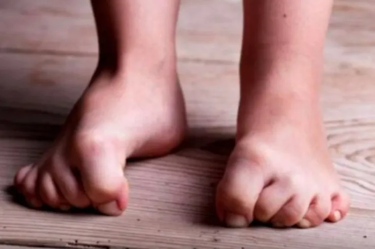 Bu sindrom sindromu parkinson xəstəliyi  riskini artıra bilər