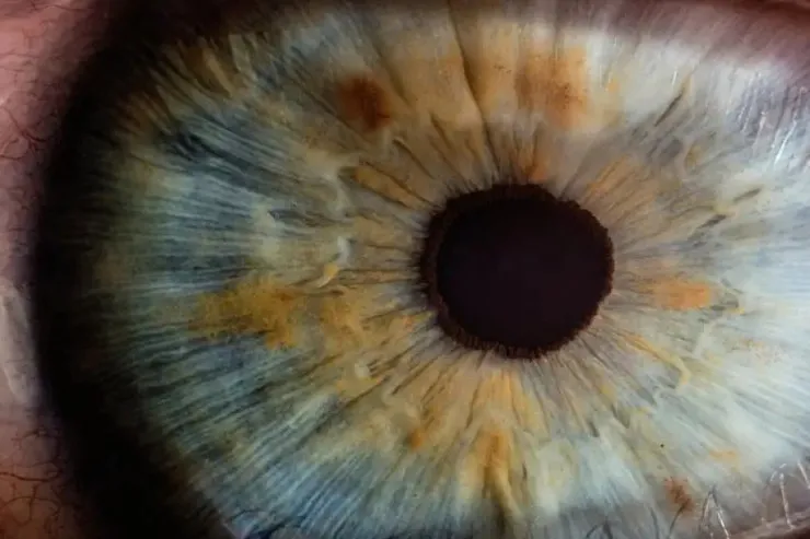 Göz skanları qocalma və ürək xəstəliyi riskini göstərə bilər - ARAŞDIRMA 