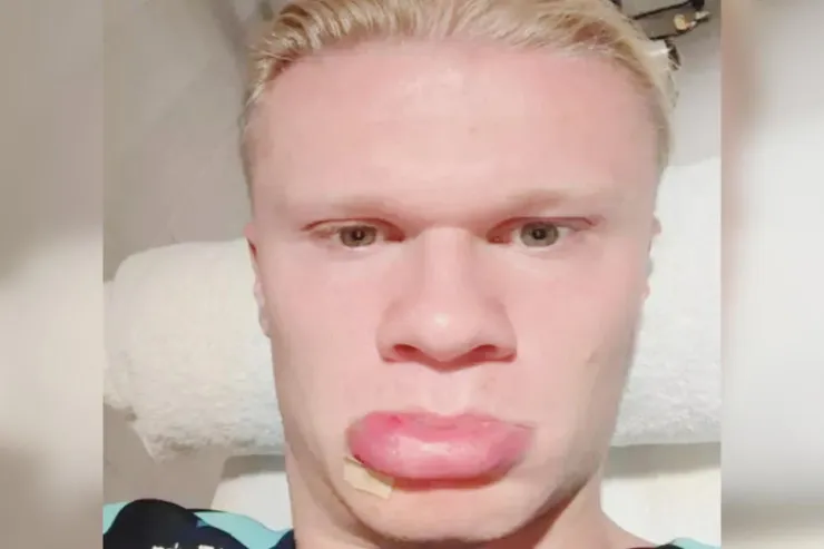 Qəzaya düşən Erlinq Haalandın son halını görənlər onu tanıya bilmir 