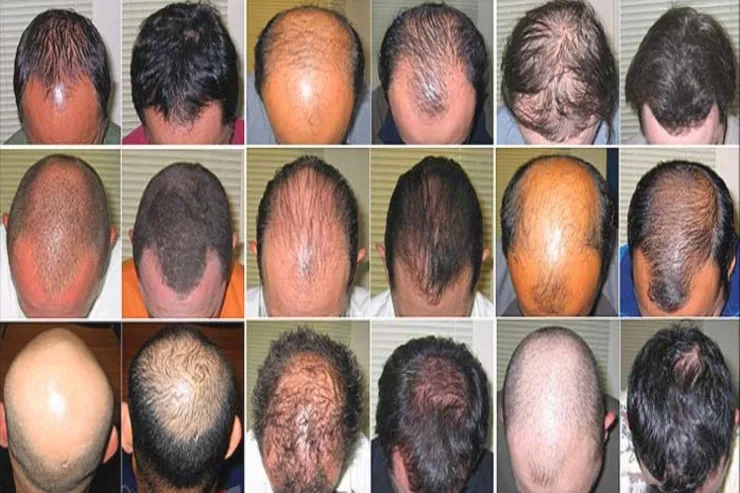 Saç tökülməsinin  12 gizli SƏBƏBİ 