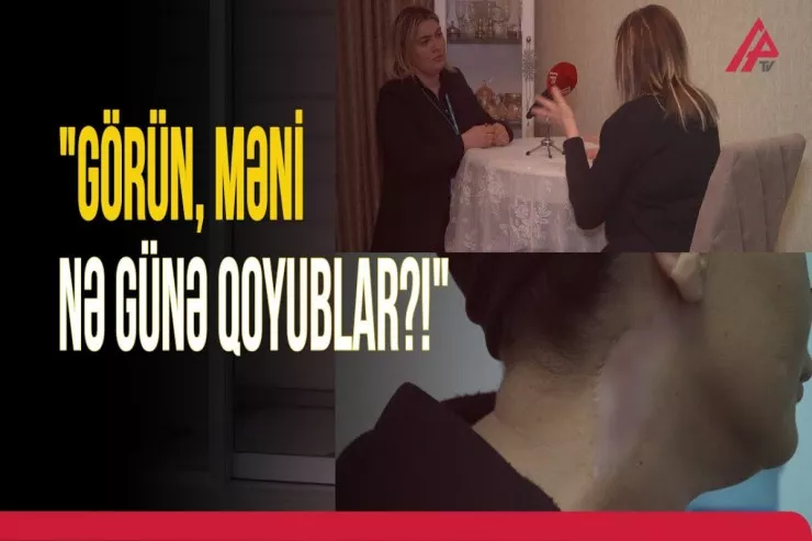 Uğursuz əməliyyatın  qurbanı danışır: "Cəhənnəmi yaşadım, çapıq qaldı”  -VİDEO 