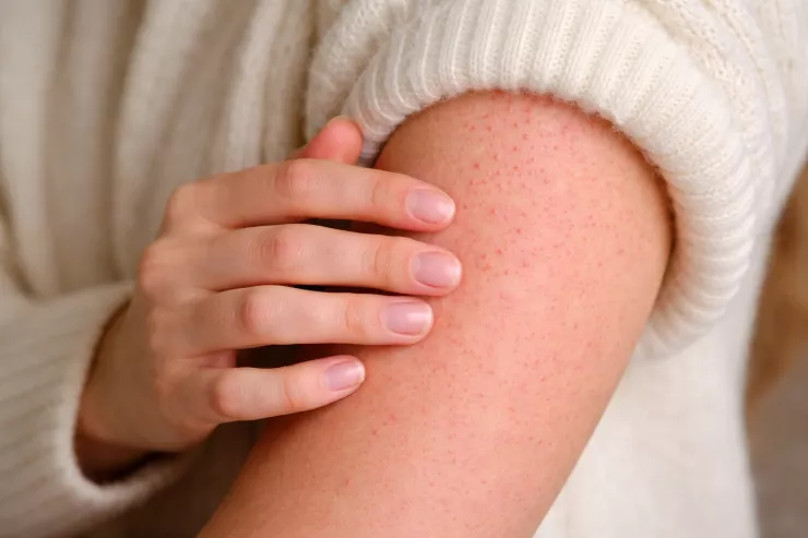 Niyə qışda əllərdə qırmızı xırda qabarcıqlar  yaranır?